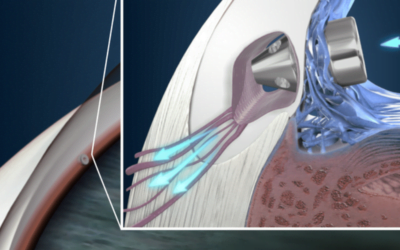Tratamiento del Glaucoma con cirugía i-stent