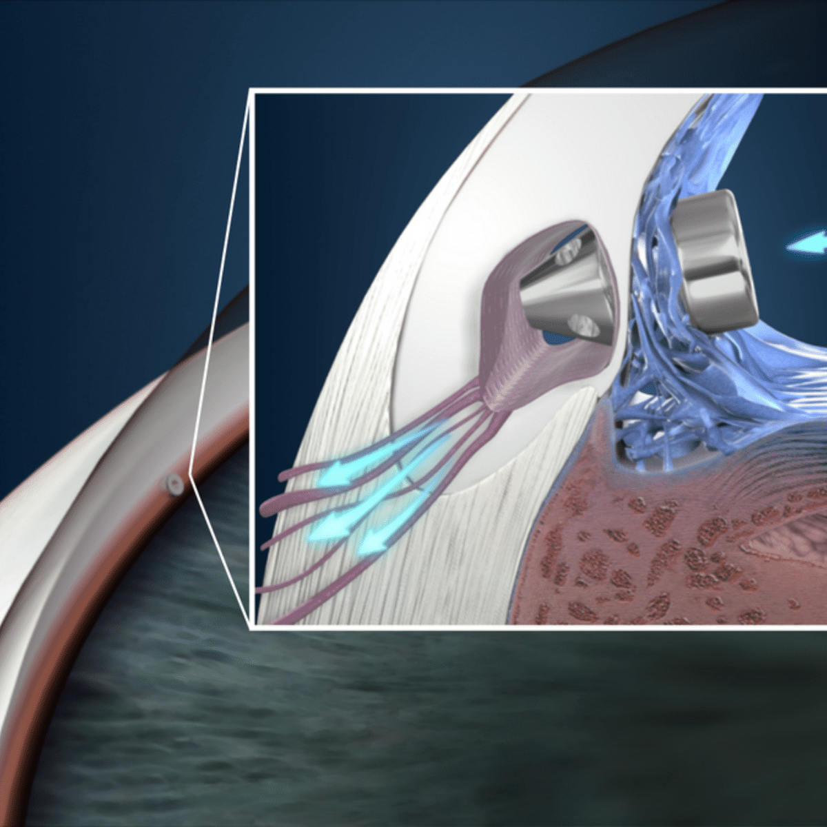 Tratamiento-del-Glaucoma-con-cirugía-i-stent