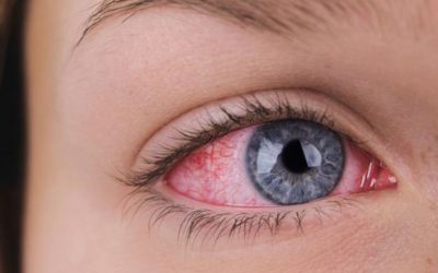 Queratitis actinica: qué es, cómo se produce y cómo prevenirla