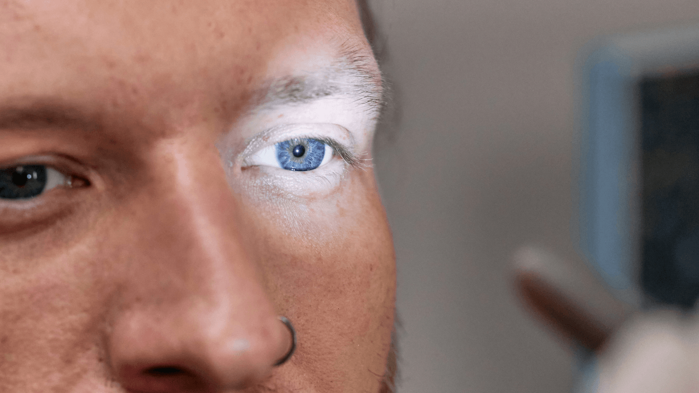  Qu Es La Fotofobia Entendiendo La Sensibilidad A La Luz