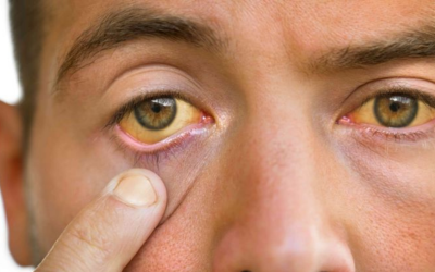 Ojos amarillos: cuáles son las señales de alerta en tu mirada y cómo tratarlos a tiempo