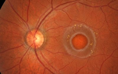 Agujero macular: síntomas, tratamiento y cuándo operar