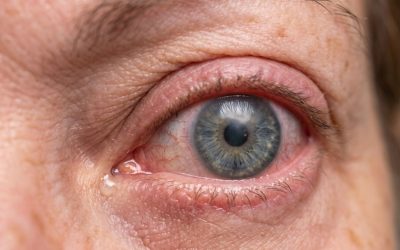 Edema macular: por qué aparece, síntomas y cómo se trata