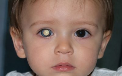 Retinoblastoma: síntomas, diagnóstico y tratamiento del tumor ocular infantil