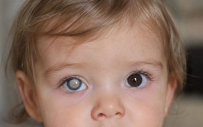Catarata congénita: causas, síntomas y tratamiento en bebés