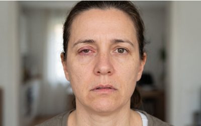 Tarsorrafia: qué es, cuándo se realiza y cómo protege la córnea
